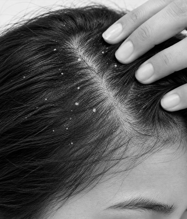 Dandruff & Damage