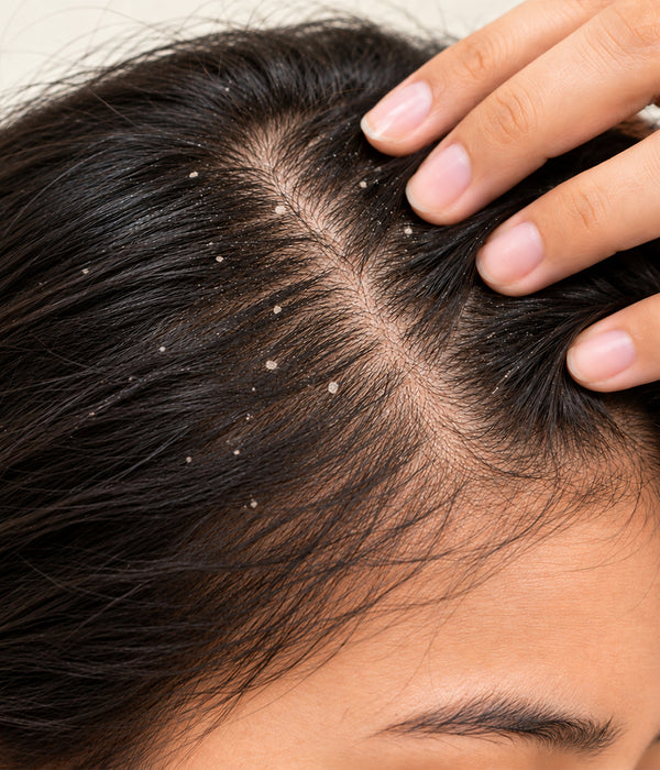Dandruff & Damage