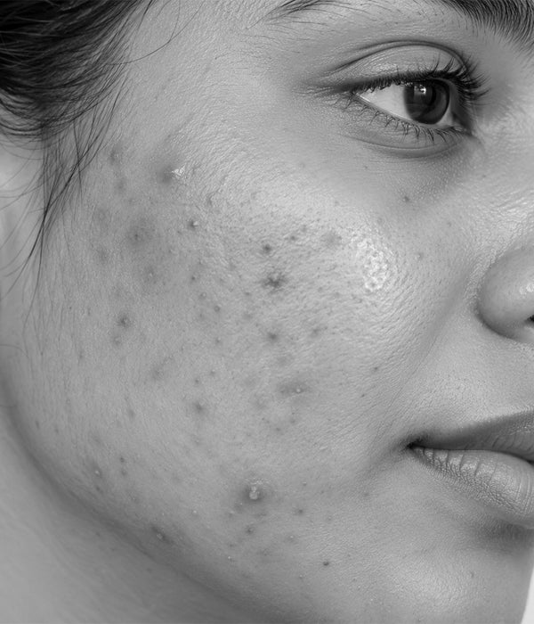 Pigmentation & Acne